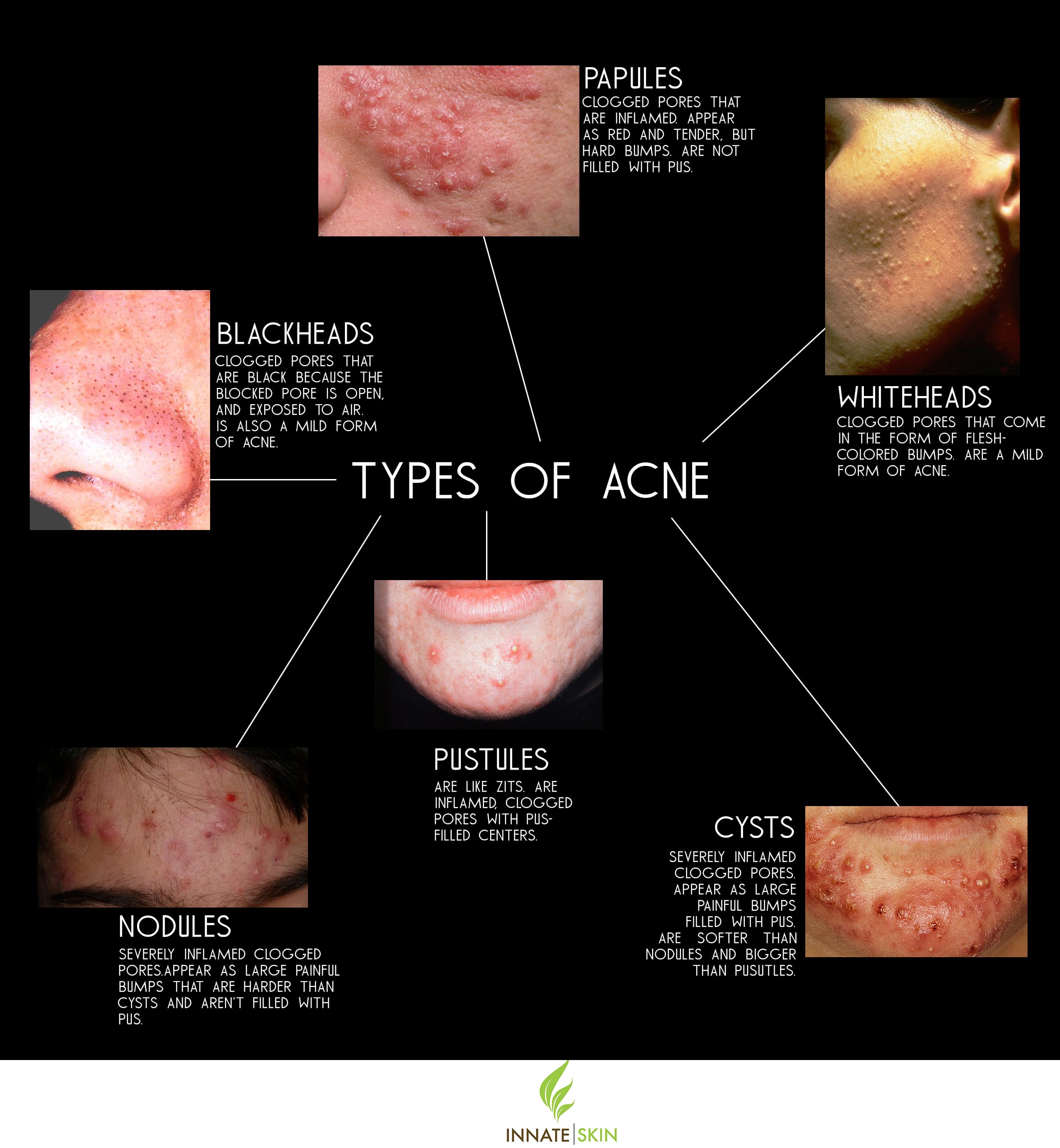 How To Recognize What Kind Of Acne You Have | Innate Skin