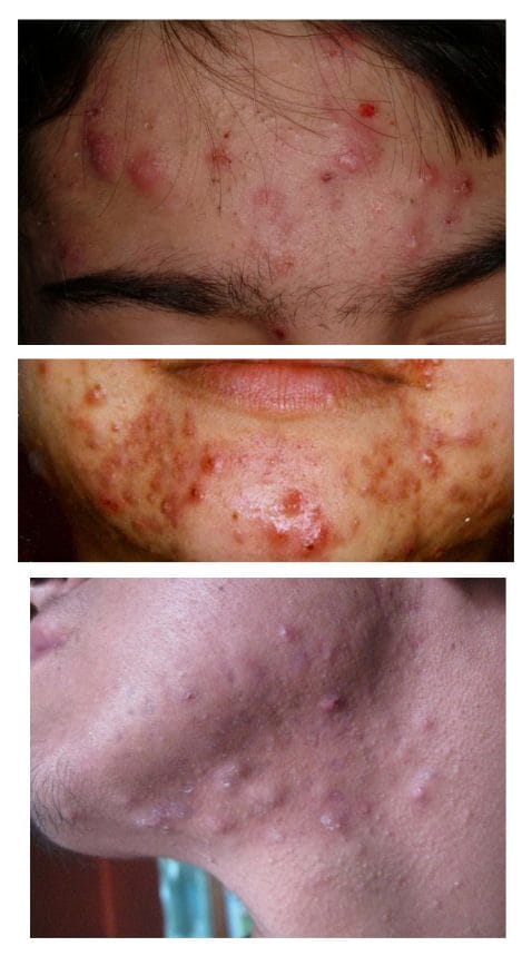 nodules