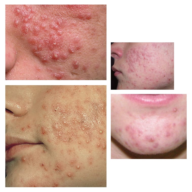 papules