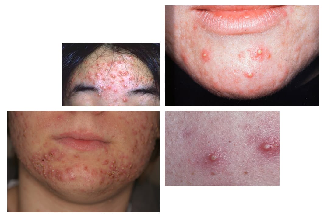 pustules