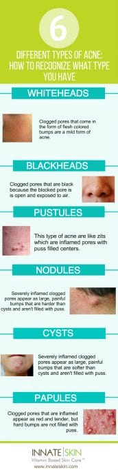 The Different Types of Acne