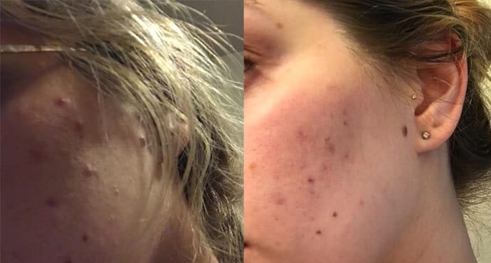 Innate Skin Results